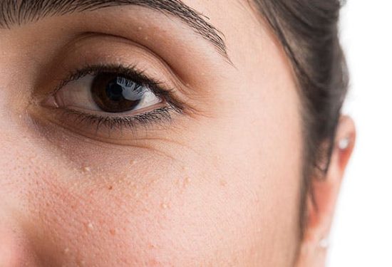 Skincare Natural Remedies That Wipes Away Pigment Spots